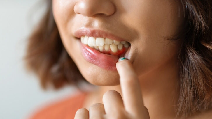 Woman pointing to lower gum area showing signs of gum recession and tooth sensitivity.