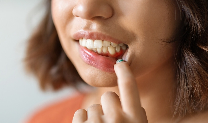 Woman pointing to lower gum area showing signs of gum recession and tooth sensitivity.