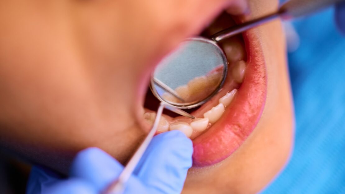 Dentist using dental mirror to examine patient's teeth during oral health checkup.