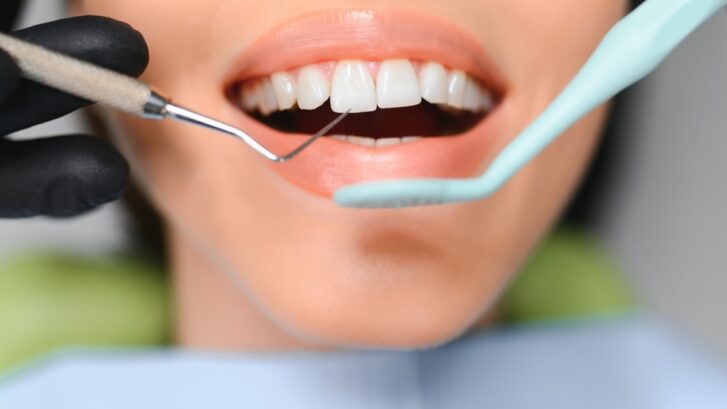 Dentist examining patient's teeth with dental tools during oral examination.