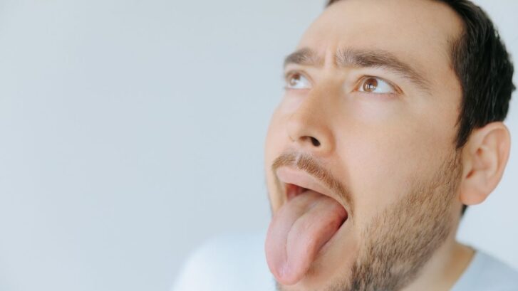 Man with fissured tongue sticking out, showing tongue condition symptoms.
