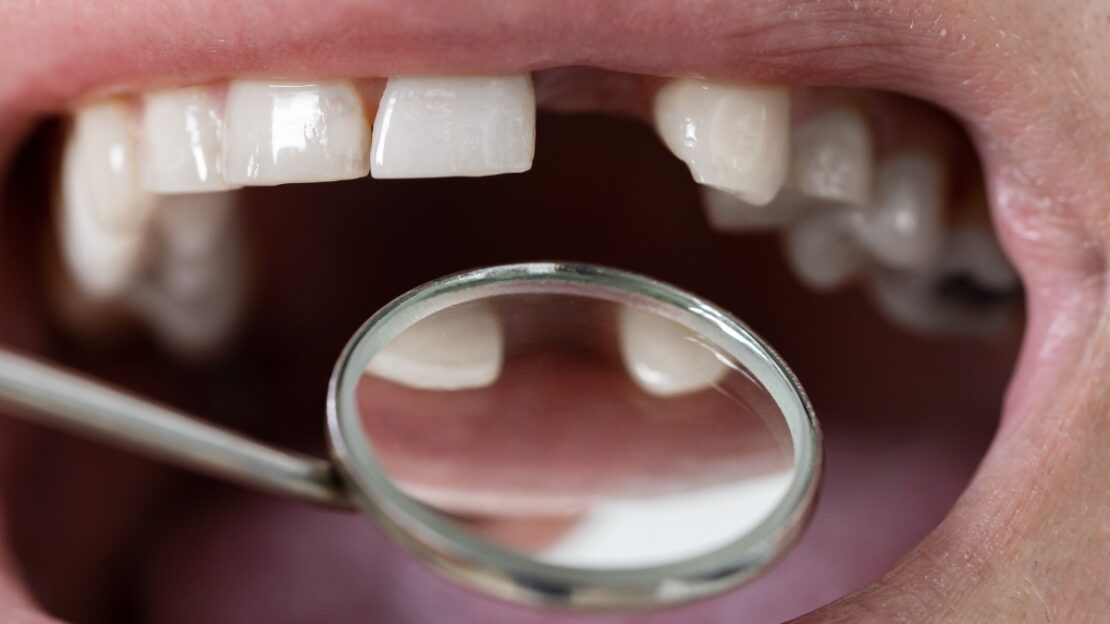 Dental mirror reflecting missing upper front teeth during oral examination.