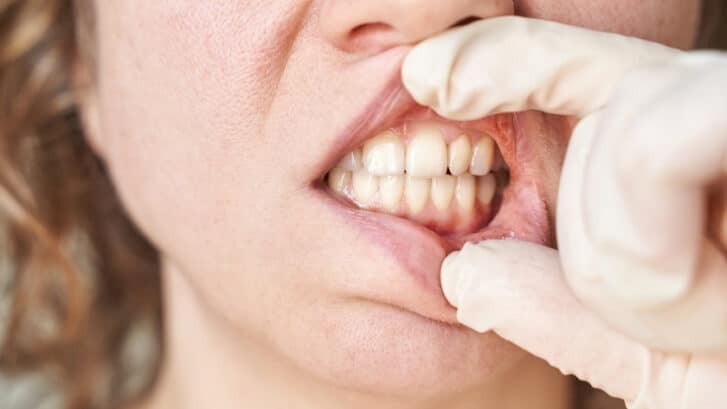 Close-up of adult teeth showing mamelons on the upper front teeth during dental examination.