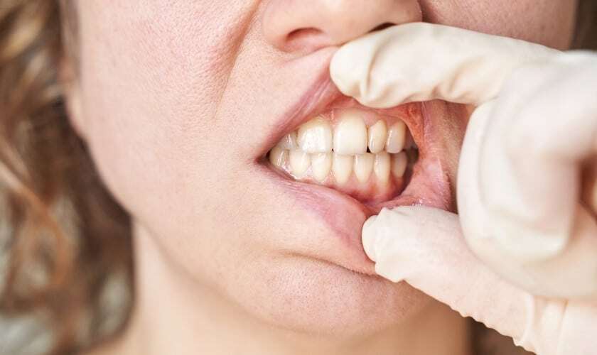 Close-up of adult teeth showing mamelons on the upper front teeth during dental examination.
