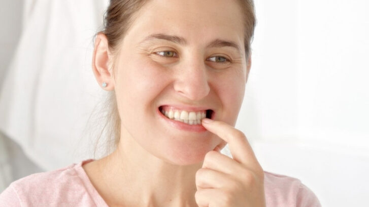Woman pointing to her teeth while smiling, showing white teeth for dental whitening treatment.