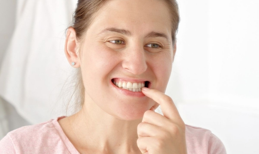 Woman pointing to her teeth while smiling, showing white teeth for dental whitening treatment.