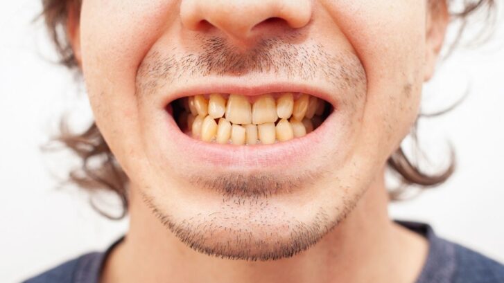 Man with yellow discolored teeth and white spots showing dental staining issues.