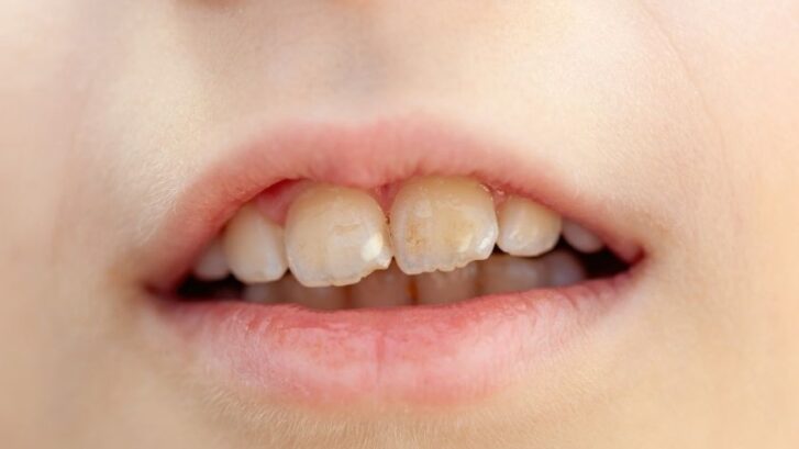 Close-up of white spots on front teeth showing early enamel loss signs.