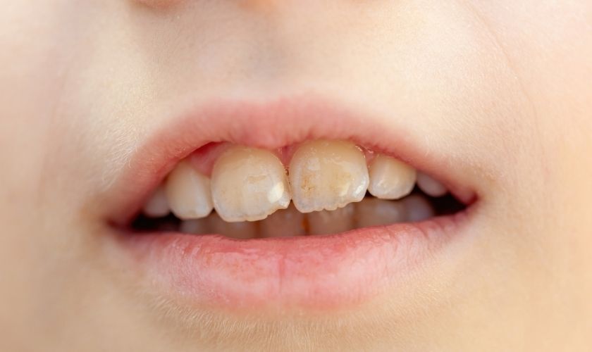 Close-up of white spots on front teeth showing early enamel loss signs.